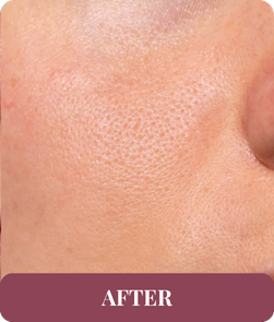 After treatment
